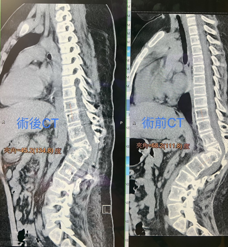 (Left) Degree before surgery, (Right) Degree after surgery. Photo of Congenital Spinal Abnormality - liberty times net