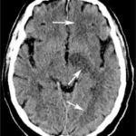 example CT of cerebral infarction