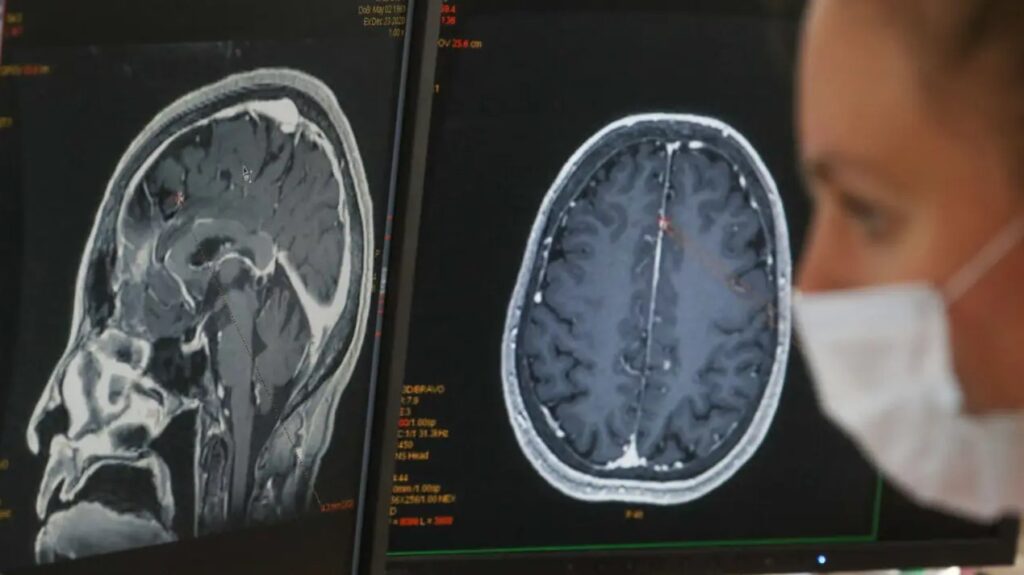 Extended brain fog may be a common symptom after COVID-19 infection, according to study (fox10phoenix)